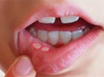  Tri metoda që shërojnë pezmatimin e gojës