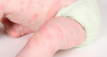  Shkaktarët e alergjisë së lëkurës te fëmijët