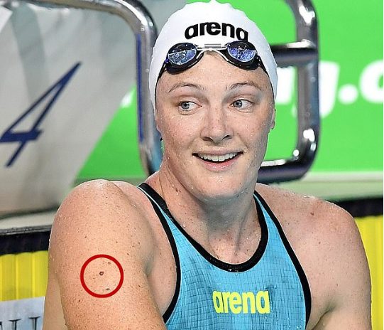 Notarja australiane parandaloi kancerin e lëkurës në një pikë